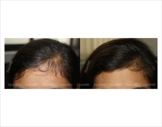 Female-hair-loss-before-after-result-34