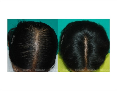 Female-hair-loss-before-after-result-39