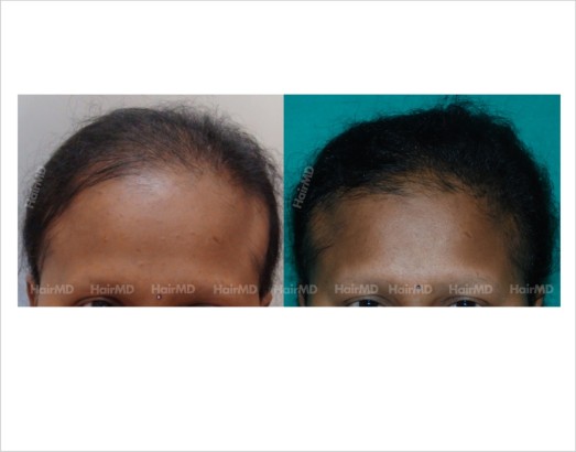 Female Hair Loss - Causes, Treatment & Prevention - HairMD
