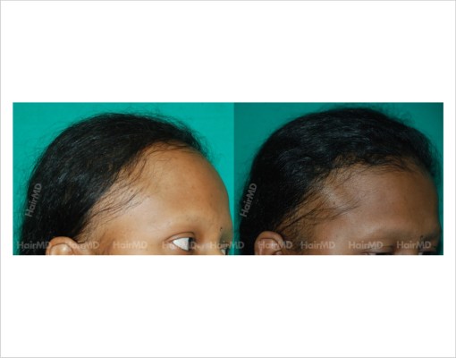 Female-hair-loss-before-after-result-48