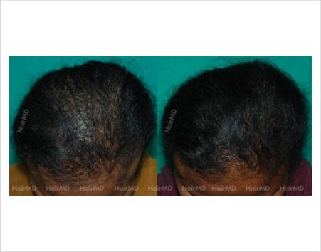 Female-hair-loss-before-after-result-50