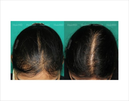 Female-hair-loss-before-after-result-56
