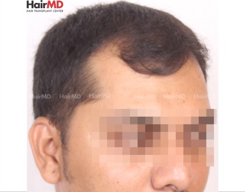 Hair Transplant male first day of consultation