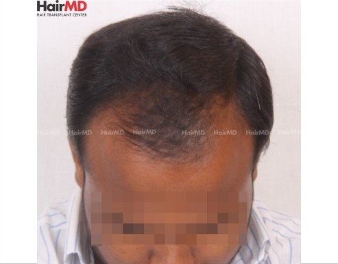 Male Hair Loss Pattern
