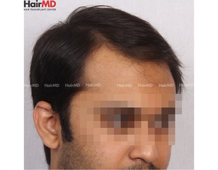 Hair Loss In Males