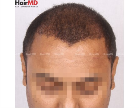 FUE Hair Transplant in Pune and Treatment Timeline, HairMD