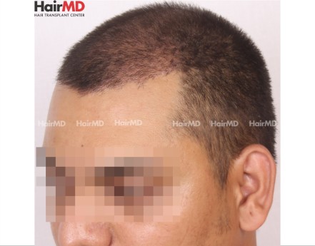 Male Hair Transplant Results After 15 Days