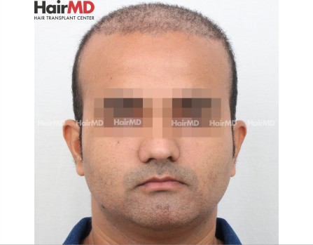 Male Hair Transplant Results After 2 Weeks