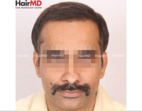 Fue Hair Transplant Results After 5 Months