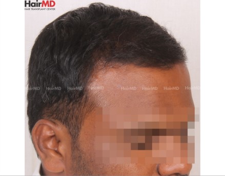 Before And After Hair Transplant Result  Best Hair Transplant in Kerala