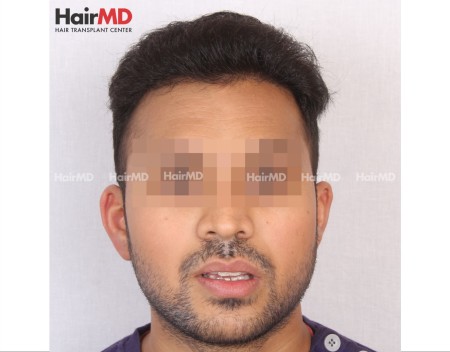 Male Hair Transplant Results After 5 Months