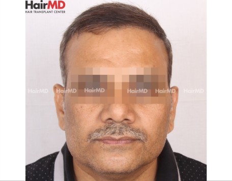 Male Hair Transplant Results After 6 Months