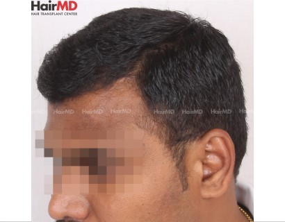 Male Hair Transplant Results After 9 Months