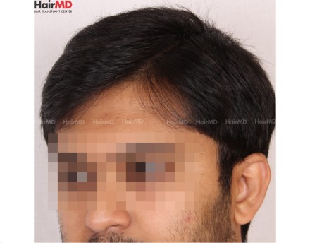 FUE Hair Transplant in Pune and Treatment Timeline, HairMD