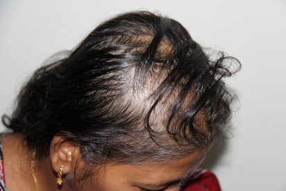 hair loss treatment women