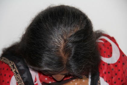 Hair loss treatment in Pune