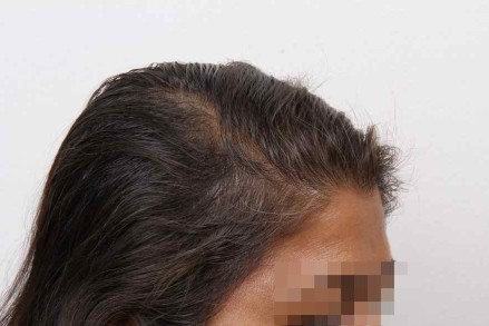 Hair loss treatments women