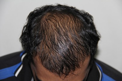 Hair Loss in Men - Treatments and Solutions | HairMD
