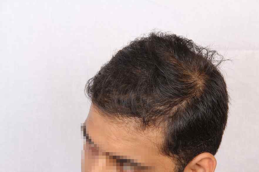 First alopecia treatment for autoimmune disorder that causes sudden hair  loss approved by the FDA