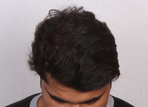 hair loss treatment in men