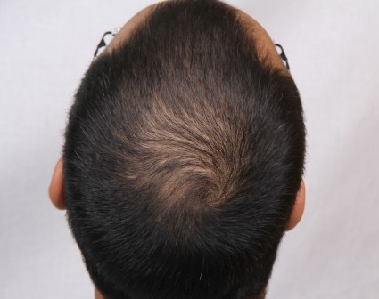Mens Hair loss Treatments and Solutions  Hair Transplant Network