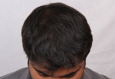 Hair loss treatment for men in Pune