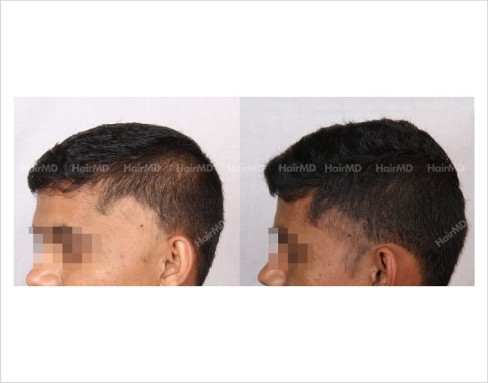 Male-alopecia-areata-before-after-2