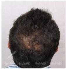 What are the causes of hair loss in 20s in male?