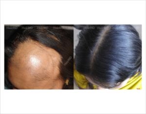 What is Alopecia Areata? - hairmd