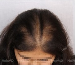 What are the female baldness causes.