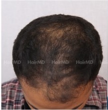 Does DHT cause hair loss?