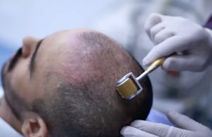 Dermaroller Treatment for Hair Loss: All You Need To Know - hairmd