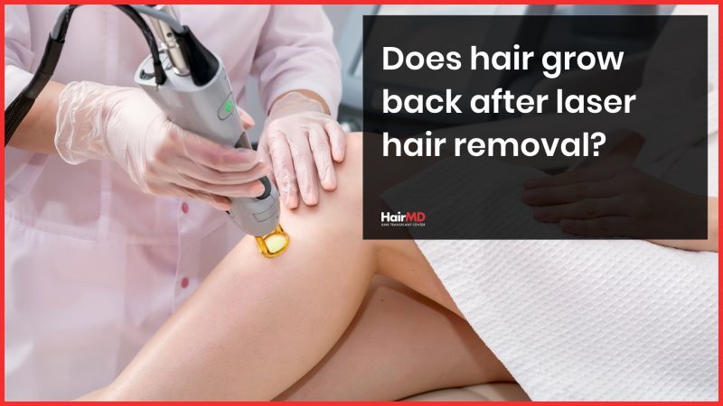 Does hair grow back after laser hair removal? - hairmd