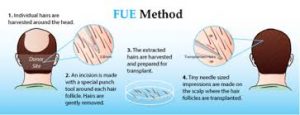 Follicular Unit Extraction (FUE) hair transplant method