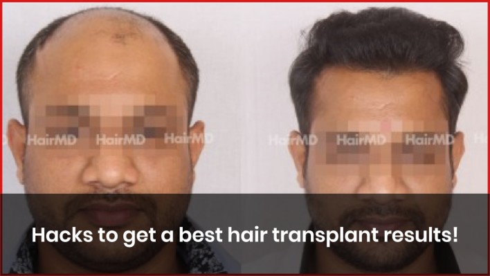 Hacks to get a best hair transplant results! - hairmd