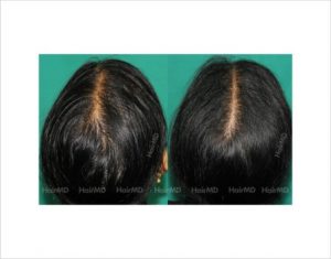 Thinning hair Causes types treatment and remedies