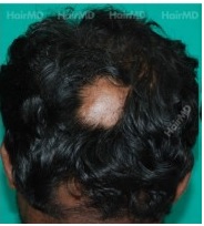 How to prevent alopecia areata?