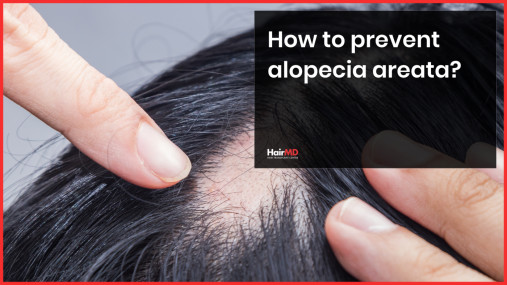 Alopecia Areata: Food Diet, Home Remedies And Treatments - hairmd