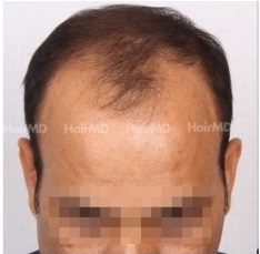 How to prevent baldness in men?