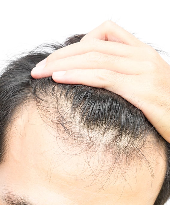 What is Frontal Baldness? | HairMD, Pune