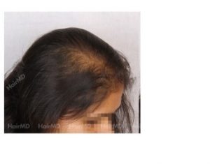 Types of hair loss in females