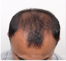 Causes of hair loss in men