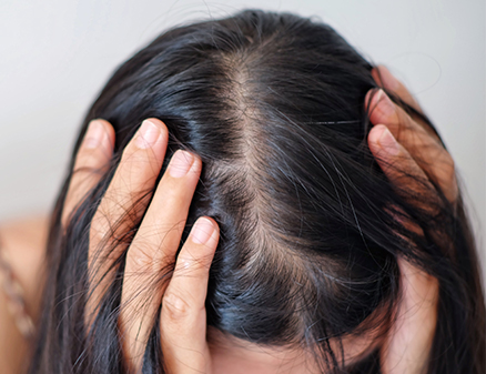 Hair Loss: Causes, Symptoms, Solutions | Everything you need to know