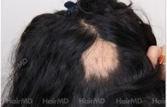 How to cure alopecia areata naturally?