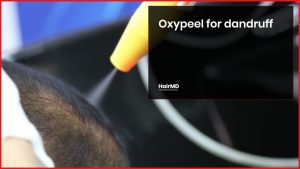 oxypeel for dandruff