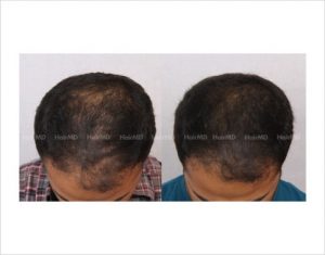prp hair treatment before and after results 300x235 1