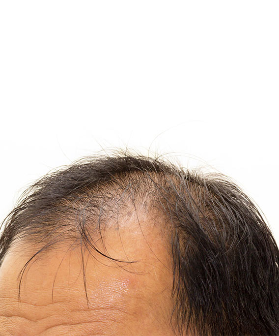 Baldness | HairMD, Pune