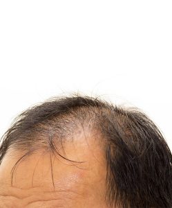 Does minoxidil work on frontal baldness?