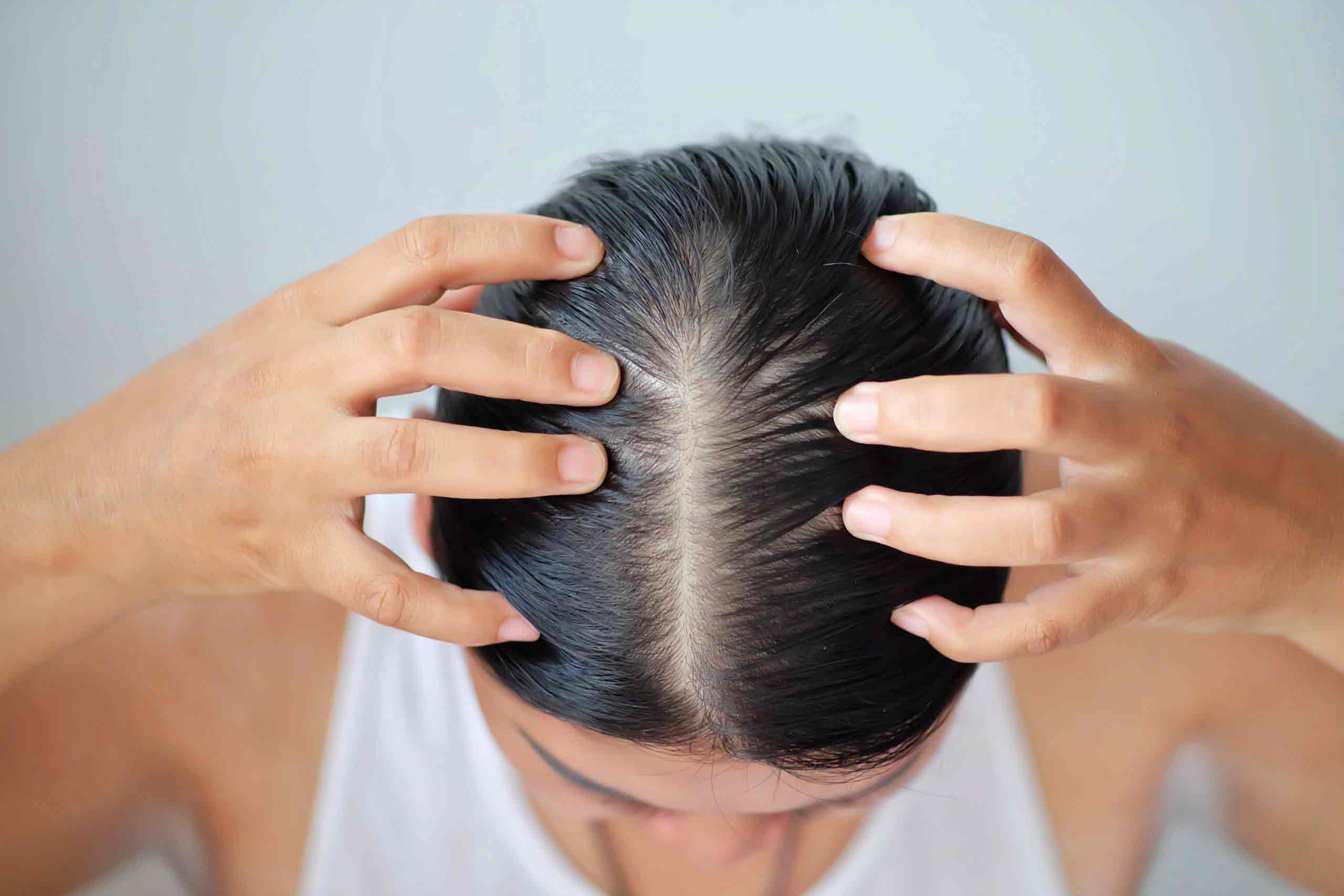 Hair Loss In Women: Everything You Need To Know | HairMD