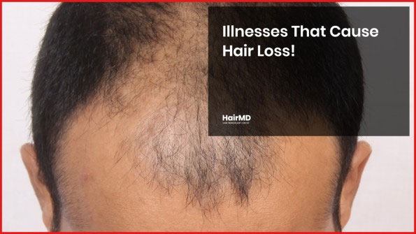 What Are The Causes Of Hair Thinning In Males